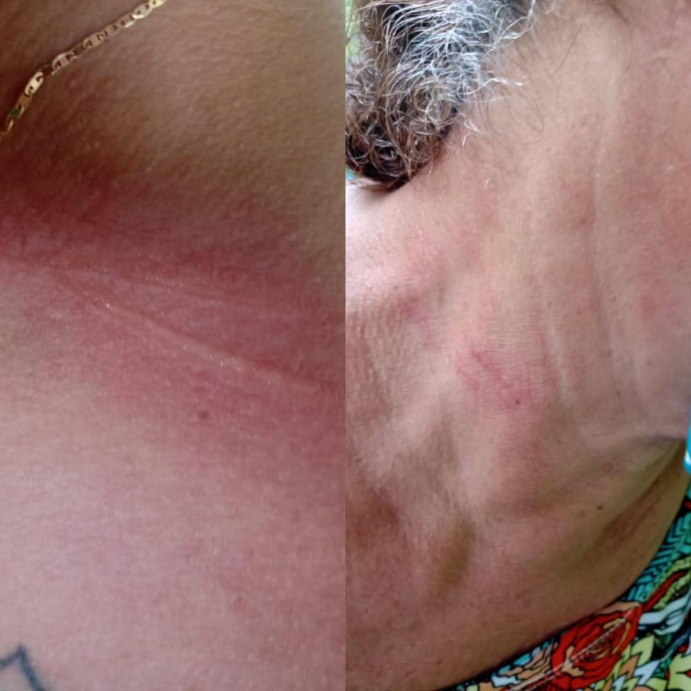 Acidente com linha de cerol atinge pescoço de professora e genitora em Parintins Acidente com linha de cerol atinge pescoço de professora e genitora em Parintins