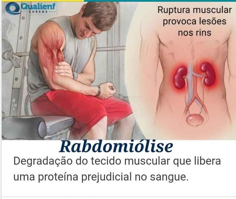 FVS-RCP registra 44 casos de rabdomiólise em seis cidades do Amazonas