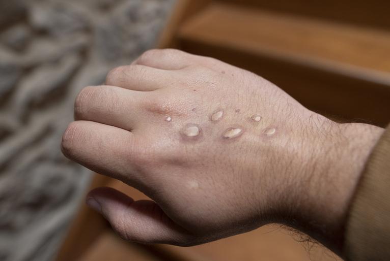 Segundo caso de varíola dos macacos 