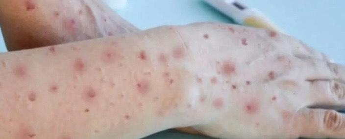 Amazonas confirma transmissão local da varíola dos macacos